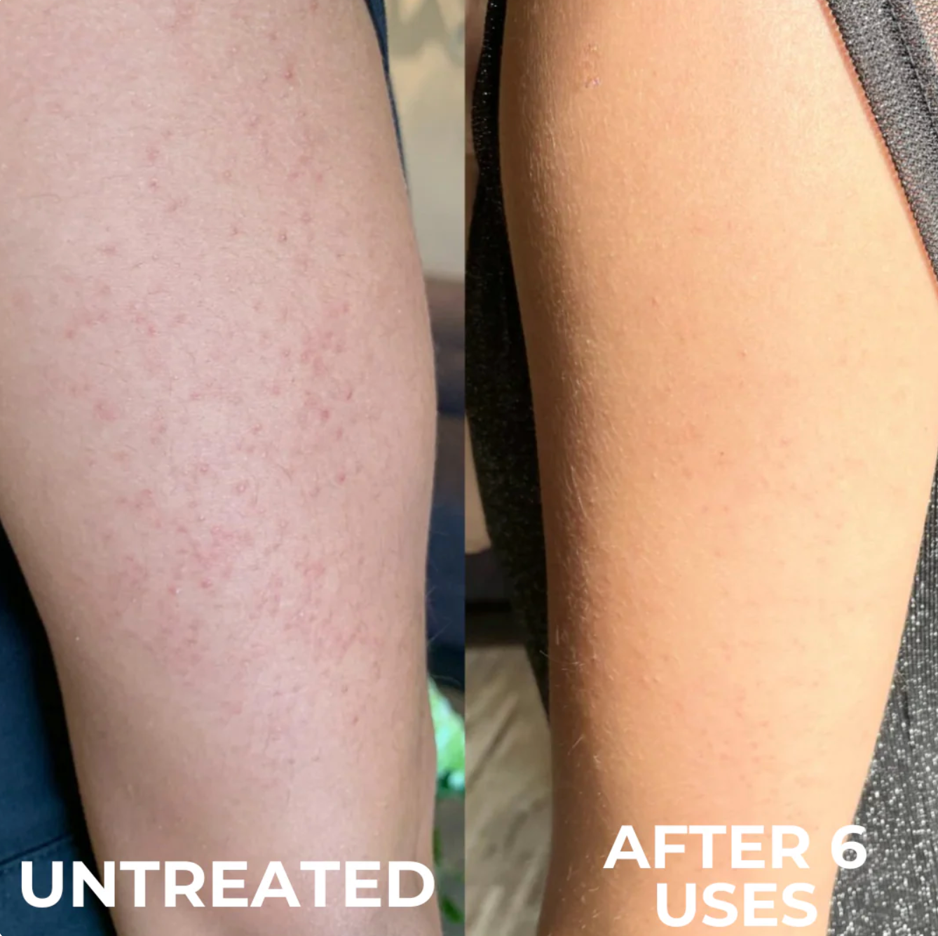 Advanced Triple-Acid Complex for Keratosis Pilaris