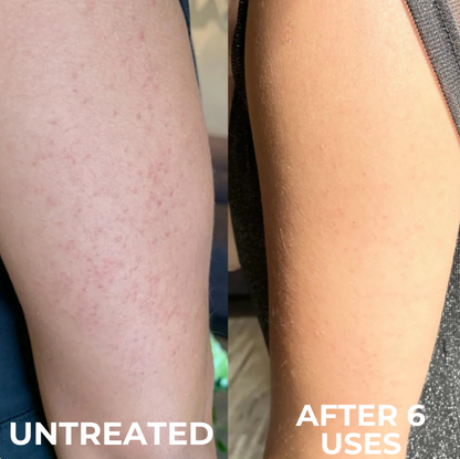 Advanced Triple-Acid Complex for Keratosis Pilaris